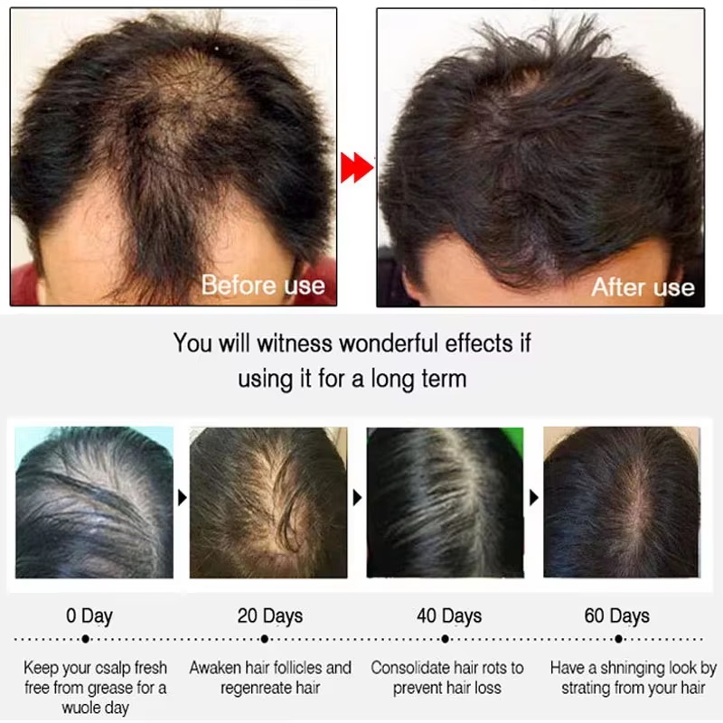 สเปรย์เร่งผมยาวขึ้นอย่างรวดเร็ - Hair Care Natural บทวิจารณ์และราคา